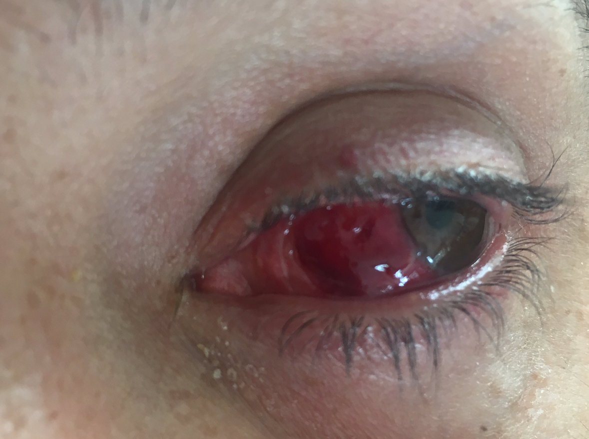 taylor-eye-2